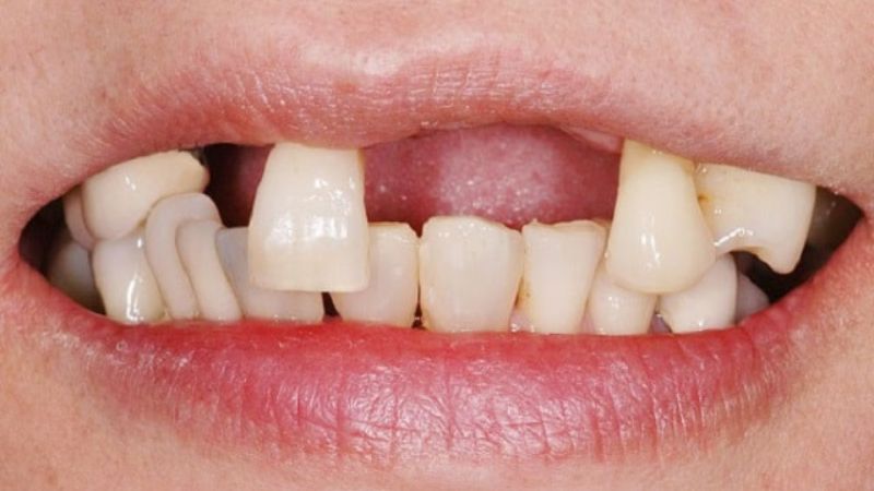 3 chiếc răng rụng cùng lúc cho thấy sự lo lắng tột cùng