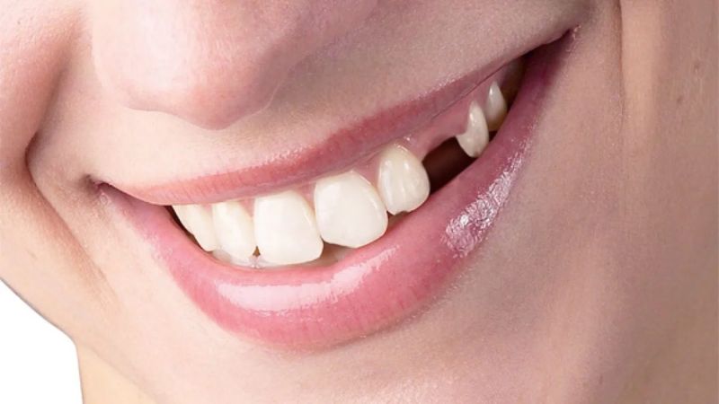 Mơ thấy rụng răng có ý nghĩa gì trong phong thủy và dân gian?